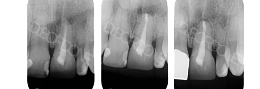 chirurgie endodontique marseille Résection apicale Dr Antonietta BORDONE - Endodontiste à Marseille