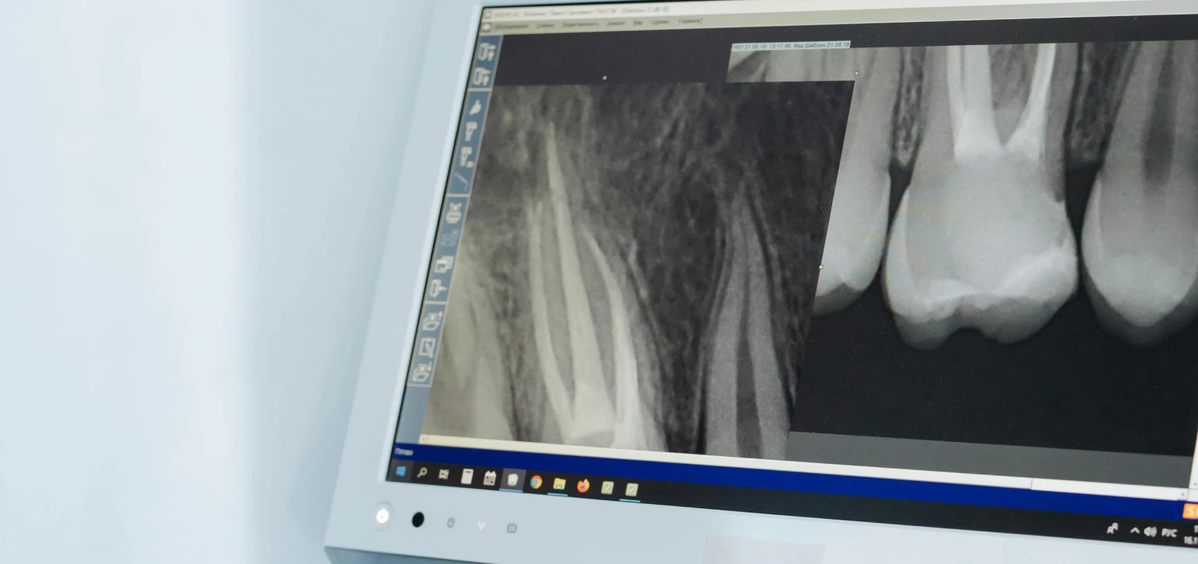 comptes rendus endodontie marseille Comptes rendus Dr Antonietta BORDONE - Endodontiste à Marseille