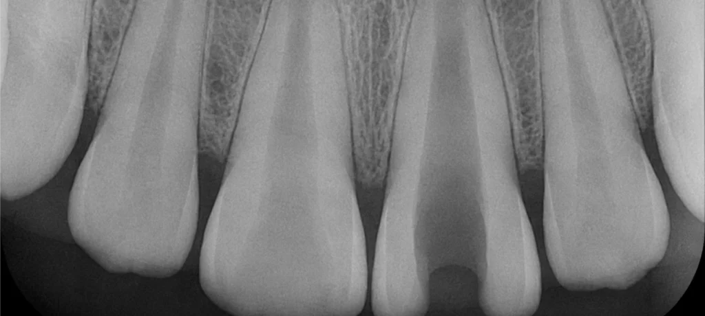 dent immature marseille Traitement dent immature Dr Antonietta BORDONE - Endodontiste à Marseille