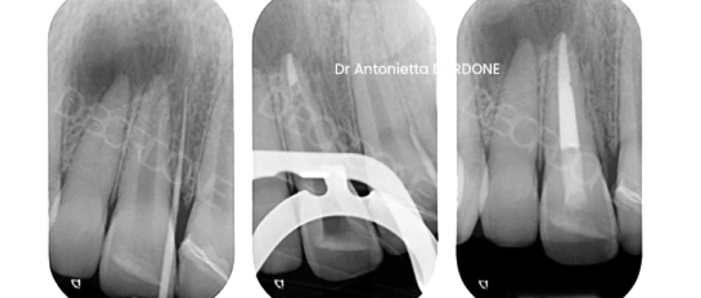 endodontie marseille apexification Traitement dent immature Dr Antonietta BORDONE - Endodontiste à Marseille