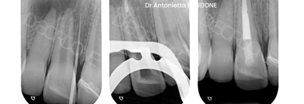 endodontie marseille apexification endodontie marseille apexification Traitement dent immature Dr Antonietta BORDONE - Endodontiste à Marseille