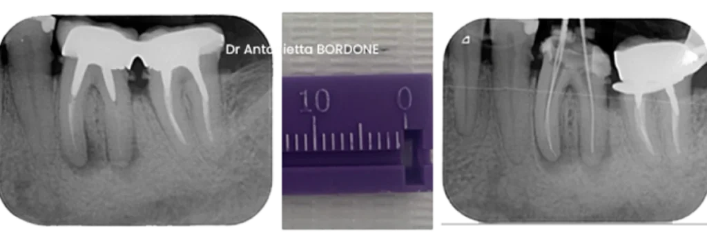endodontie marseille retrait instrument fracture Fracture d’un instrument Dr Antonietta BORDONE - Endodontiste à Marseille