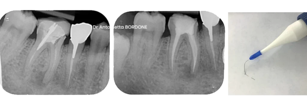 endodontie marseille retrait instrument fracture canal Fracture d’un instrument Dr Antonietta BORDONE - Endodontiste à Marseille