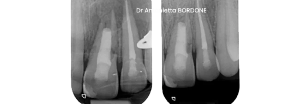 endodontie marseille revascularisation revitalisation endodontie marseille revascularisation revitalisation Traitement dent immature Dr Antonietta BORDONE - Endodontiste à Marseille