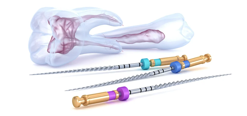 endodontie racine devitalisation marseille x endodontie racine devitalisation marseille x Endodontie Dr Antonietta BORDONE - Endodontiste à Marseille