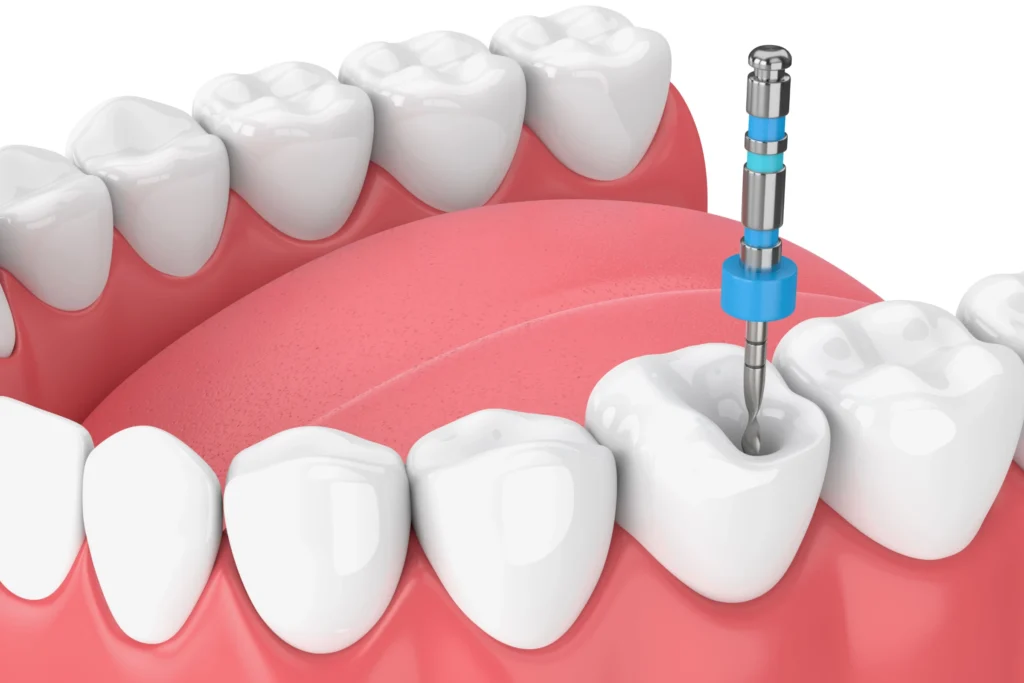 endodontie traitement racines marseille Traitement canalaire Dr Antonietta BORDONE - Endodontiste à Marseille