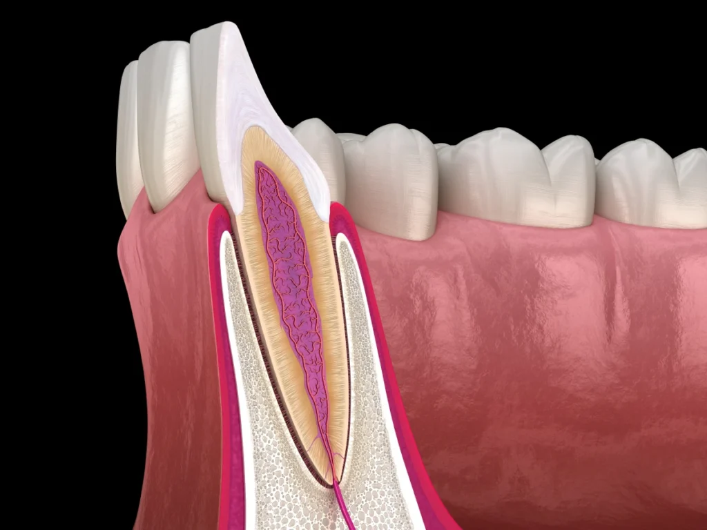 resection apicale endodontie marseille resection apicale endodontie marseille Endodontie Dr Antonietta BORDONE - Endodontiste à Marseille