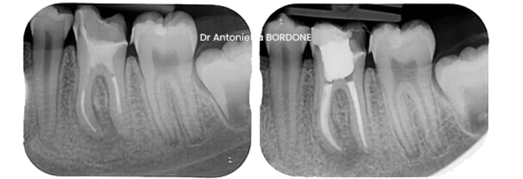 retraitement canalaire endodontie marseille Retraitement canalaire Dr Antonietta BORDONE - Endodontiste à Marseille