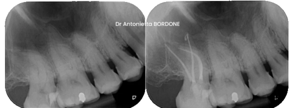traitement canalaire initial endodontiste marseille Traitement canalaire Dr Antonietta BORDONE - Endodontiste à Marseille