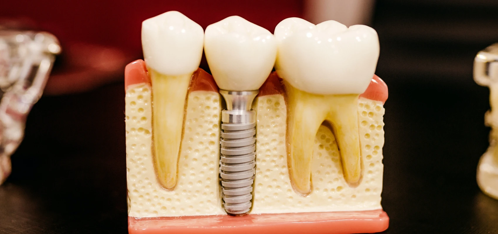 traitement dent immature endodontiste marseille Traitement dent immature Dr Antonietta BORDONE - Endodontiste à Marseille