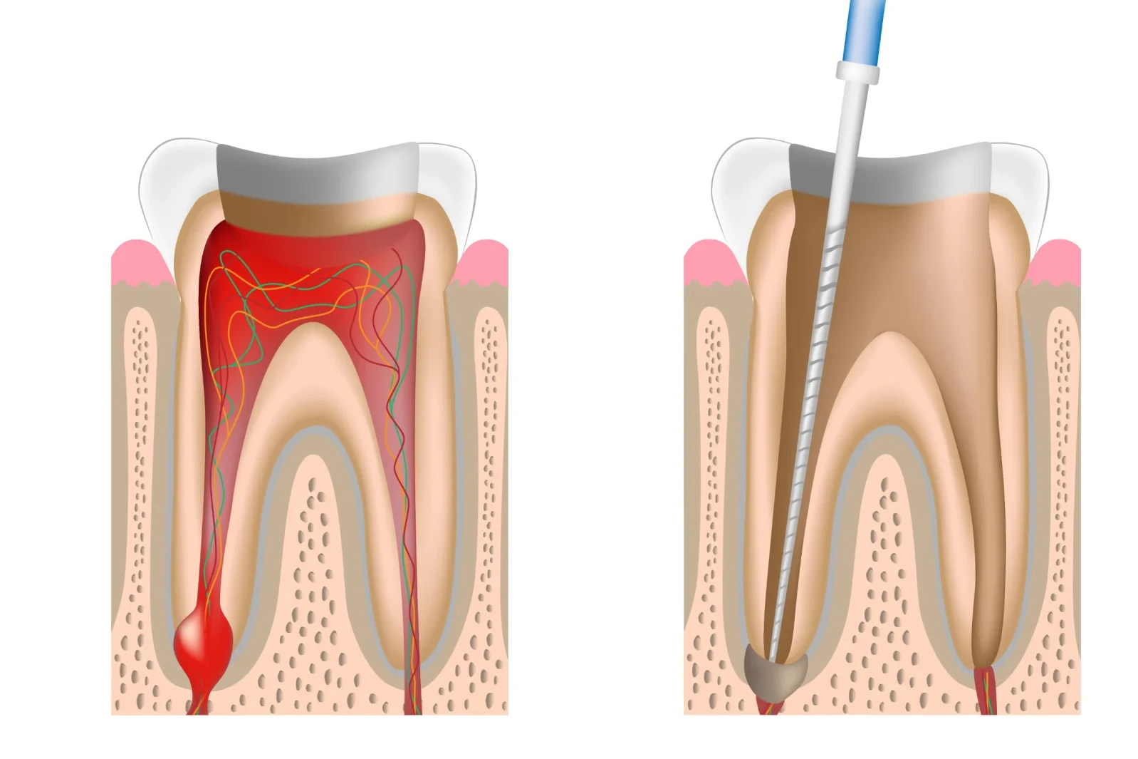 endodontie marseille endodontie marseille Endodontie Dr Antonietta BORDONE - Endodontiste à Marseille